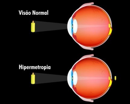 hipermetropia